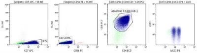 Controversial Flow Cytometry Monitoring of a Relapse Case of Pediatric T Cell Acute Lymphoblastic Leukemia: A Case Report